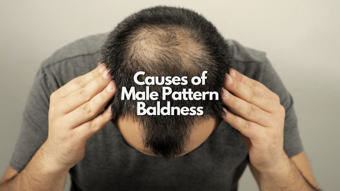 5 Causes of Male Pattern Baldness and How to Prevent Them